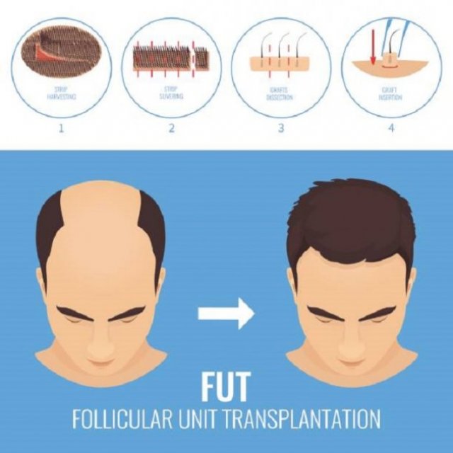 London Hair Transplant Clinic